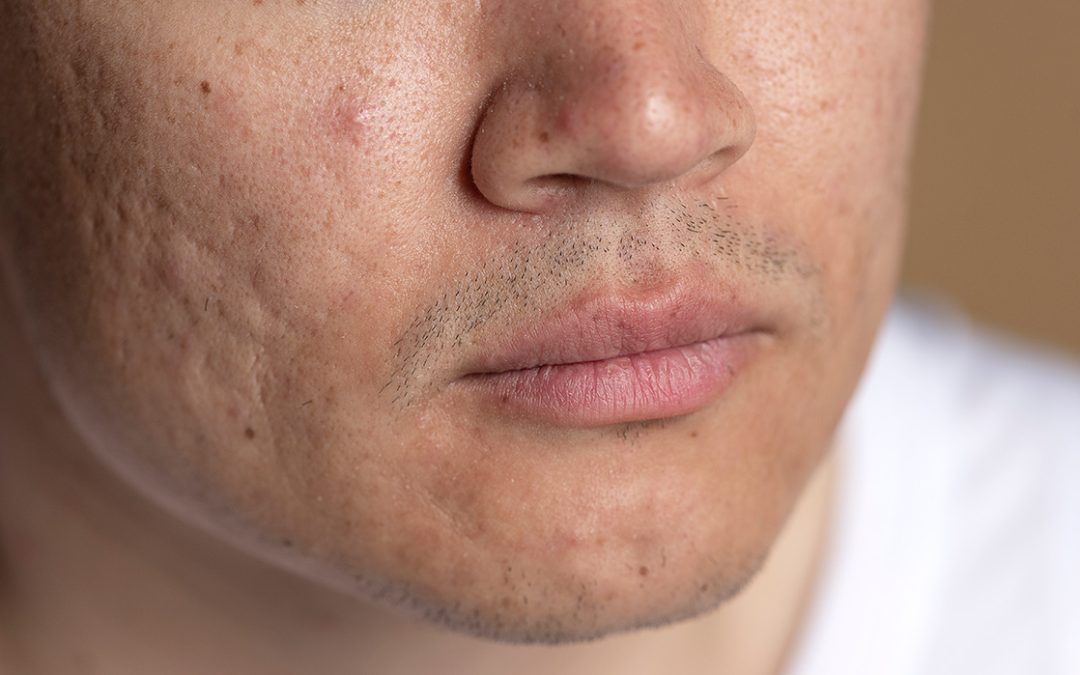 How to Treat Acne Scars Effectively: Your Complete Guide by Nazirin Skin Clinic, Kuala Lumpur