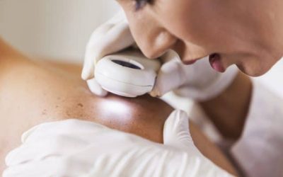 Skin Cancer: What You Need to Know (and Why Early Detection Matters)