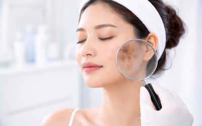 Pigmentation Treatment : Understanding Pigmentation and Dark Spots Causes